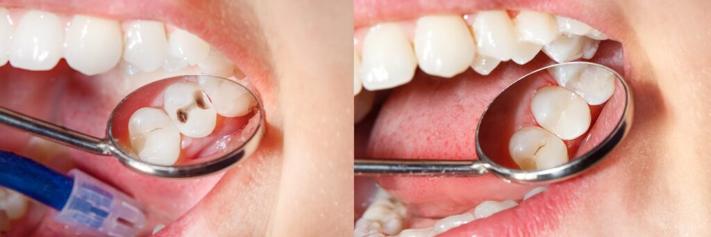 طول عمر کامپوزیت دندان و عوامل تاثیرگذار بر آن