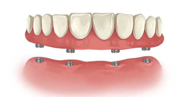 دندان مصنوعی ثابت بر پایه ایمپلنت چیست-نعمت الهی