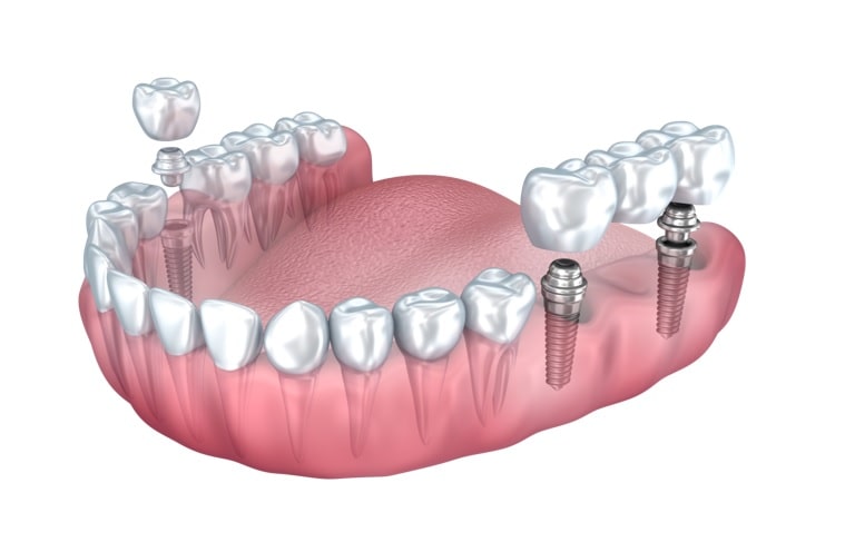 دلایل تغییر دندان مصنوعی به ایمپلنت-نعمت الهی