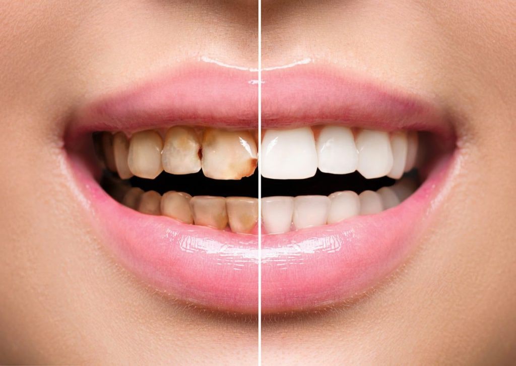 تفاوت کامپوزیت و لمینت دندان-نعمت الهی