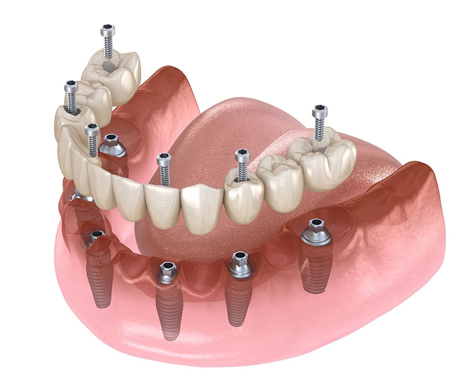 تغییر دندان مصنوعی به ایمپلنت-نعمت الهی