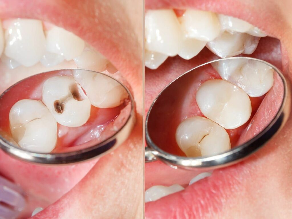 معایب کامپوزیت دندان-نعمت الهی