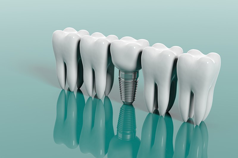 ایمپلنت های دندانی جایگزین پروتز ها-نعمت الهی