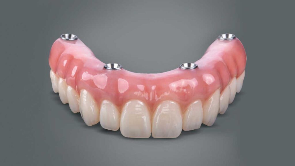 معایب دندان مصنوعی ثابت بر پایه ایمپلنت-نعمت الهی