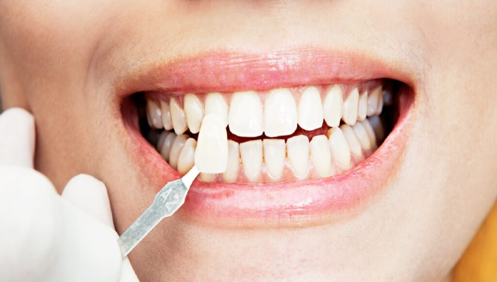 ویژگی های کامپوزیت دندان-نعمت الهی