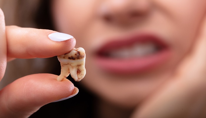 انواع پوسیدگی دندان-نعمت اللهی