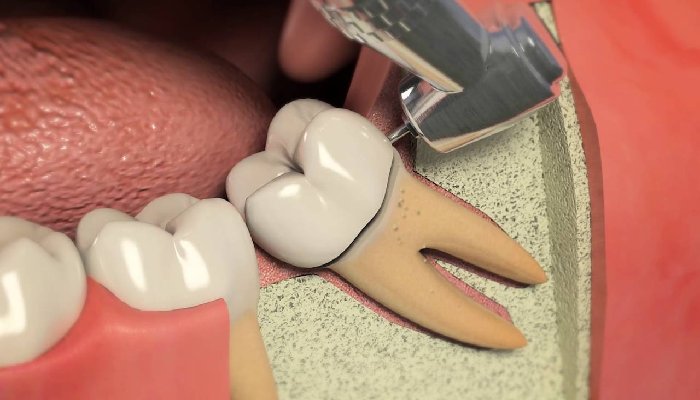 جراحی دندان عقل چقدر طول می‌کشد؟-نعمت الهی