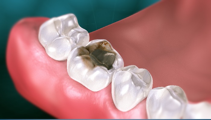 درمان پوسیدگی دندان-نعمت اللهی