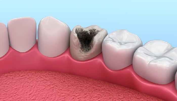 علت پوسیدگی دندان-نعمت للهی