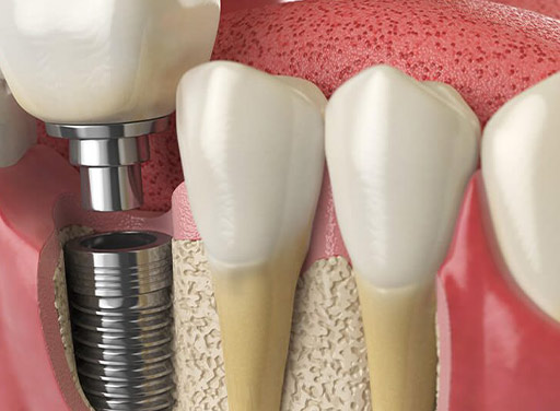 پروتز دندان چیست-نعمت اللهی