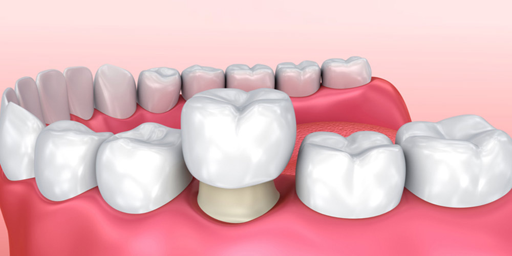 انواع روکش دندان-نعمت العی