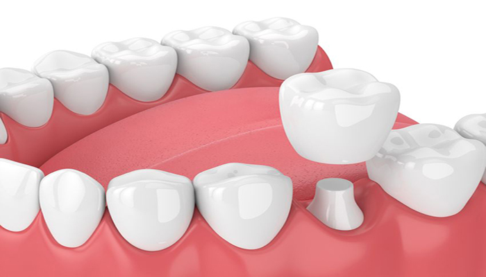 انواع پروتز دندان-نعمت اللهی