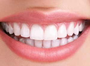 هزینه روش های بلیچینگ دندان
