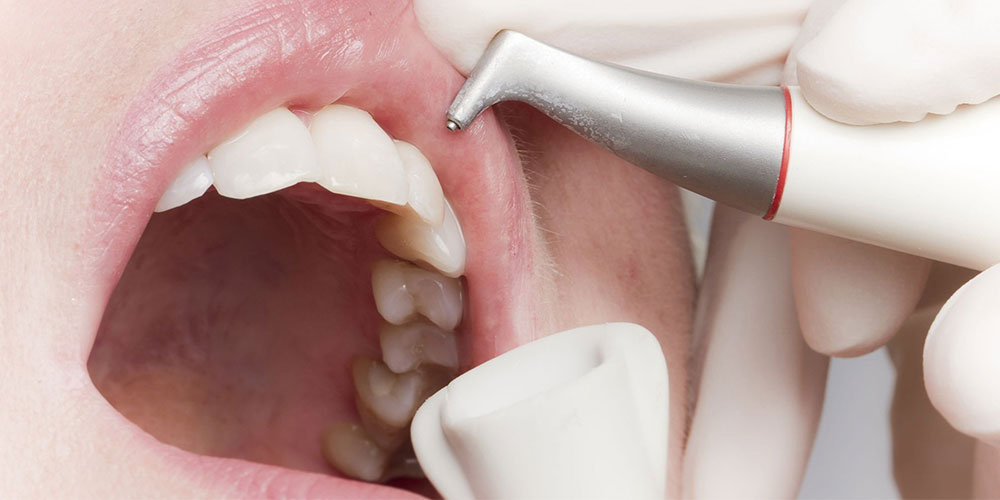 مزایای جرمگیری دندان