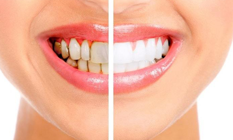سفید کردن دندان-نعمت الهی