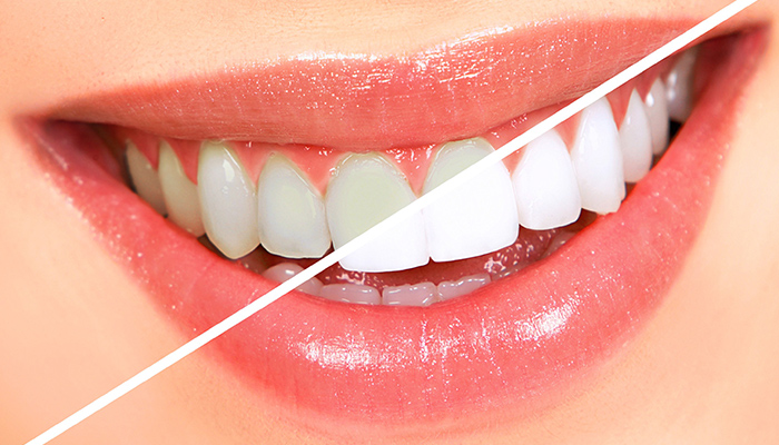 روش‌های سفید کردن دندان‌ها-نعمت الهی