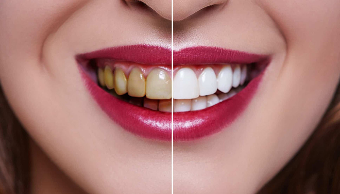 سفید کردن دندان چیست-نعمت الهی