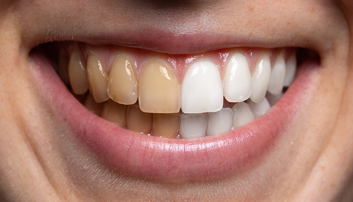 علت تغییر رنگ دندان‌ها-نعمت الهی