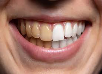 بلیچینگ دندان-نعمت الهی