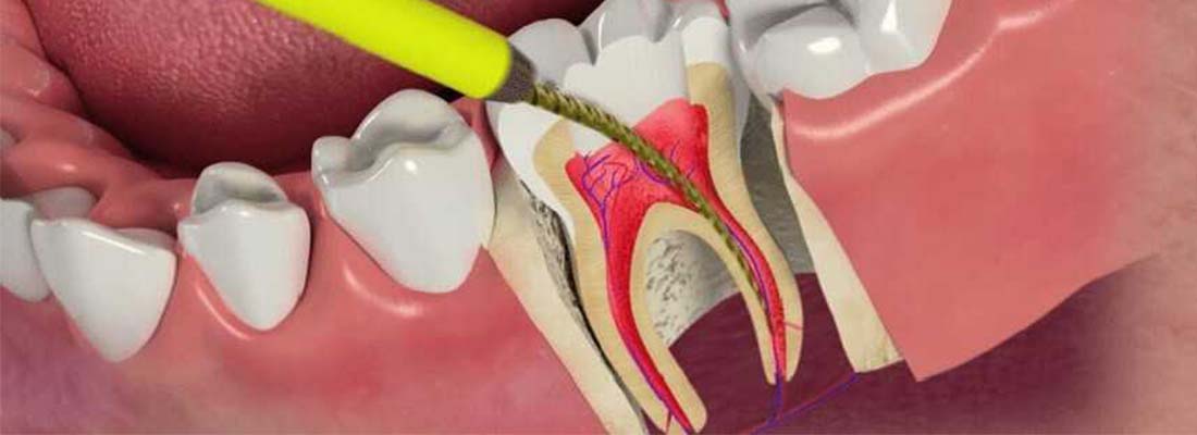 خطرات و عوارض احتمالی عصب کشی دندان-نعمت الهی