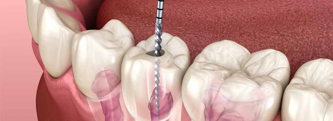 عصب‎ کشی دندان چیست-نعمت الهی