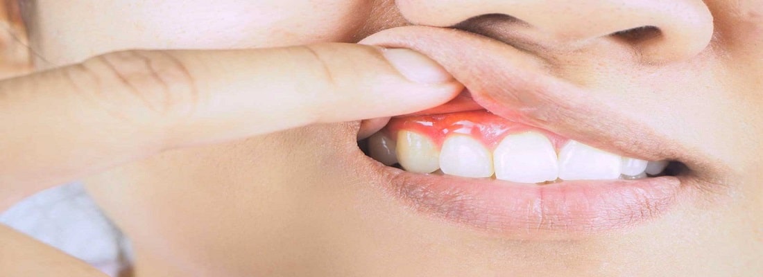 عفونت دندان و لثه-نعمت الهی