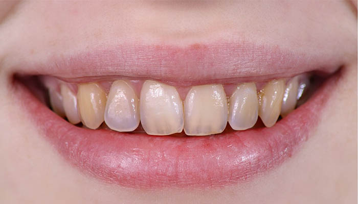 عوامل موثر در تخریب مینای دندان-نعمت الهی