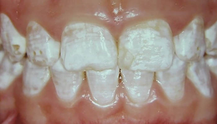 هیپوپلازی مینای دندان-نعمت الهی