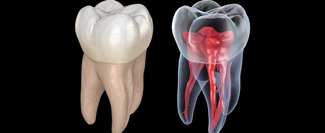 عصب کشی دندان-نعمت الهی
