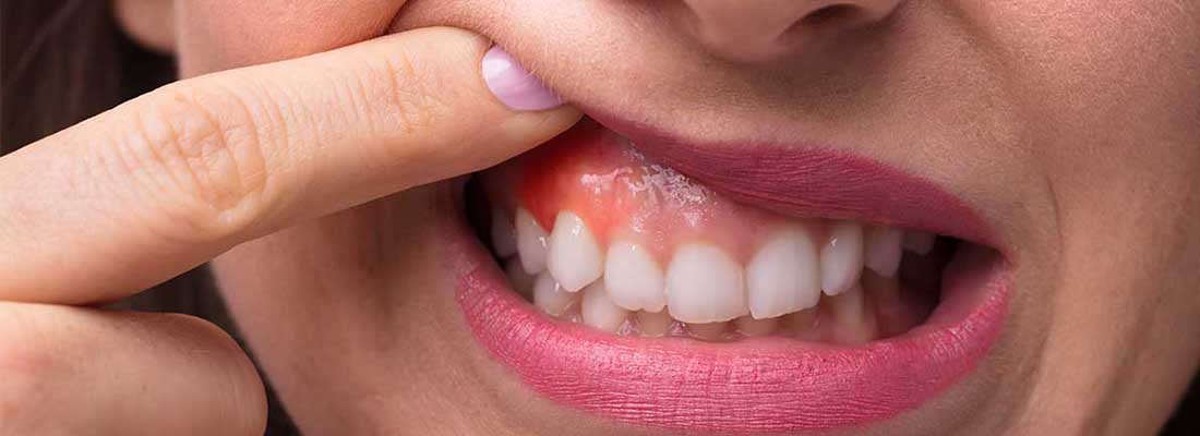 سرطان دهان و زبان-نعمت الهی
