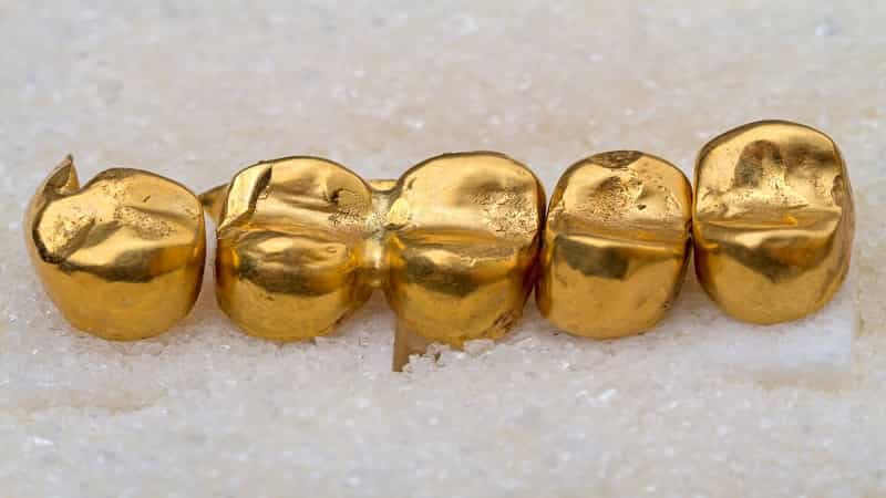 انواع تاج دندان طلا