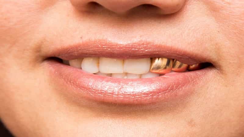 دندان طلا چیست