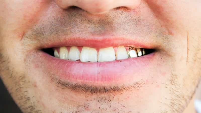 طول عمر روکش دندان طلا