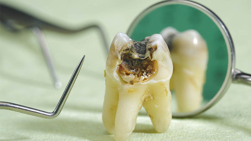 عدم درمان پوسیدگی دندان چه عوارضی به دنبال دارد؟