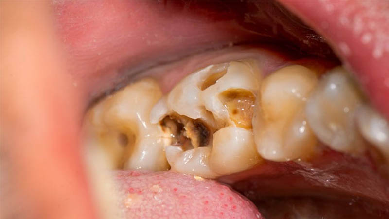 عوامل پوسیدگی دندان چیست؟