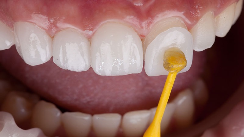 مراحل انجام دادن لمینت دندان