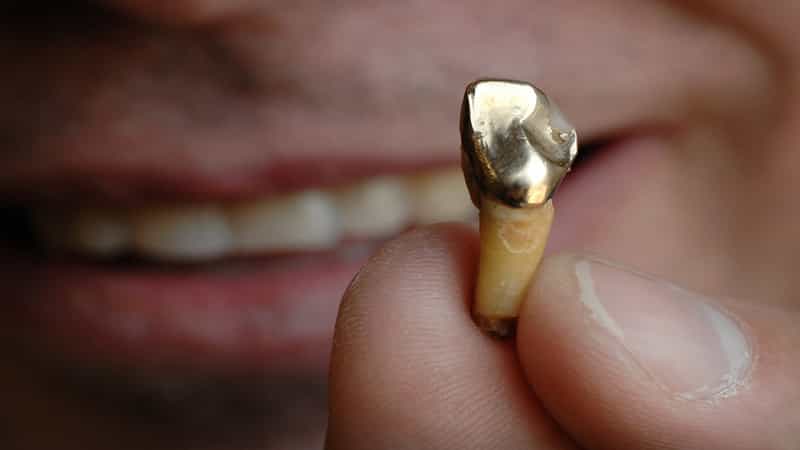 مزایا و معایب دندان طلا