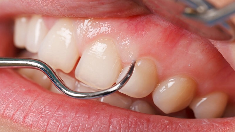 علت ایجاد پلاک دندان