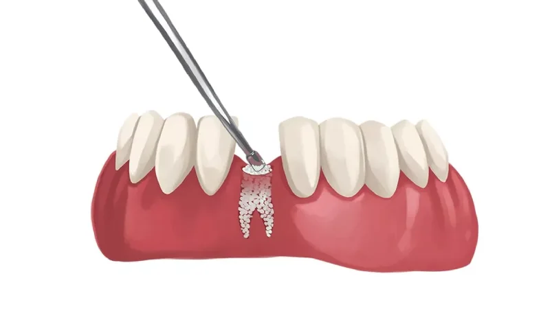 علت پیوند استخوان دندان