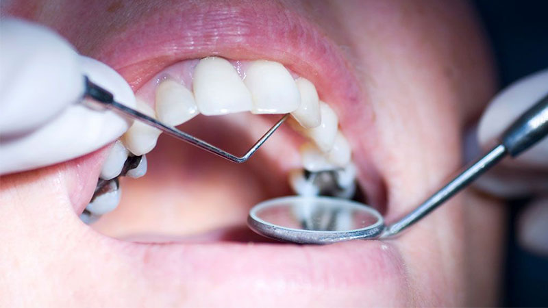 کاربرد مواد آمالگام دندان