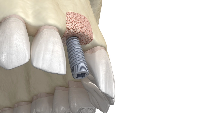 مزایای پیوند استخوان دندان