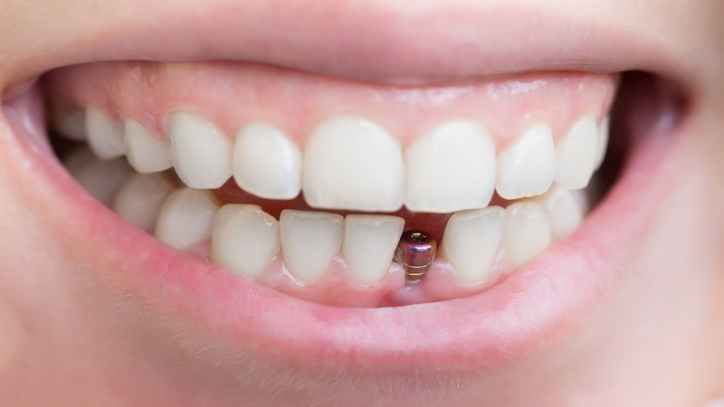 فیکسچر ایمپلنت دندان چیست 