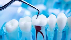 مراقبت ها بعد از درمان ریشه دندان
