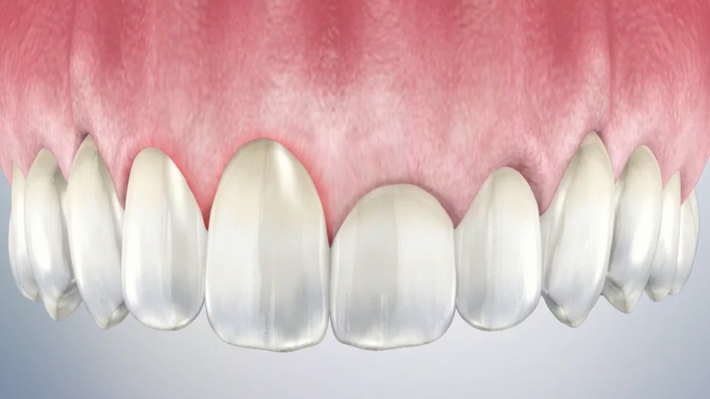 انواع روش جراحی دندان