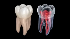 مراحل درمان ریشه دندان