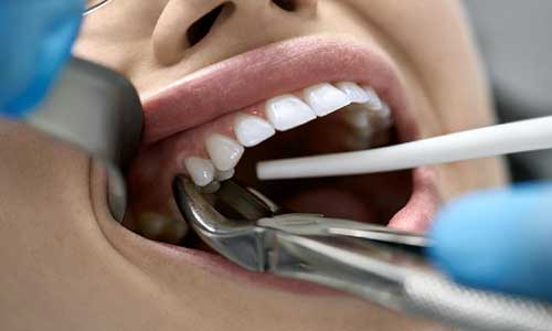 دلایل و عوارض کشیدن دندان چیست و هزینه ی آن چقدر است؟