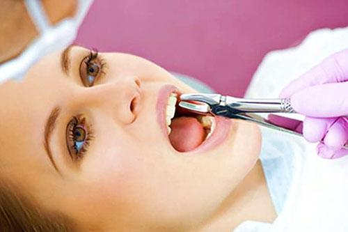 هزینه کشیدن دندان
