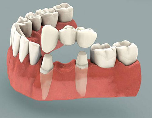 بریج دندان چیست؟ 