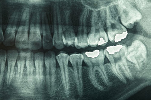 اشعه ایکس دندان