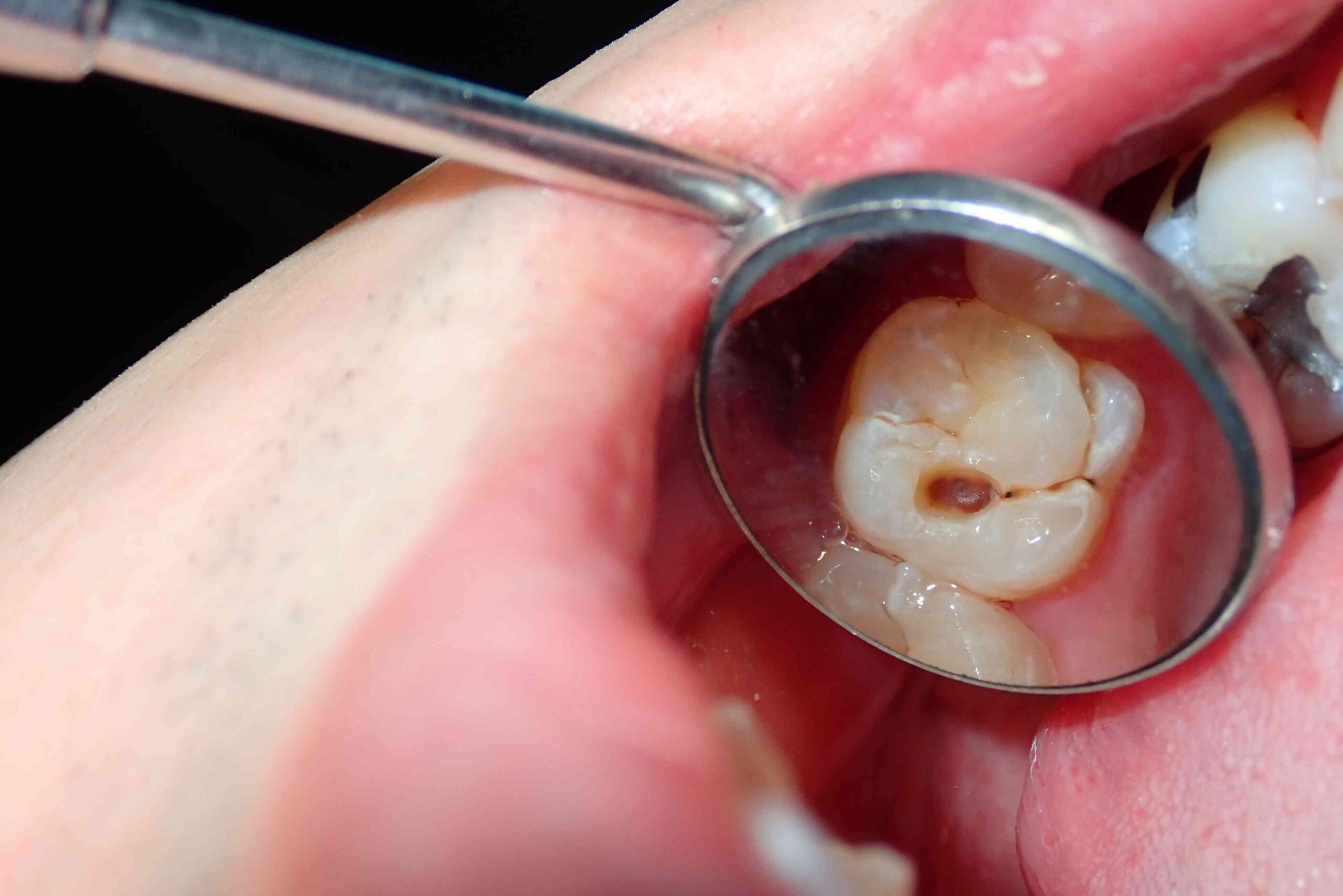 مراحل پوسیدگی دندان